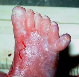 Polydactyly Postaxial (Toes)