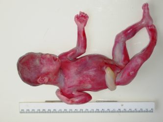 Holoprosencephaly fetus