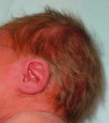 Scalp Hair Dysmorphic Pattern