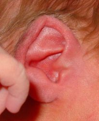 Ear Helix Dysmorphic Asymmetric