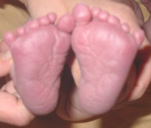 Toe Polydactyly