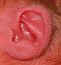 Ear Small Asymmetric