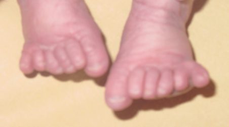 Toe polydactyly