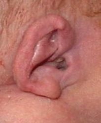 Dysmorphic Ear Asymmetric