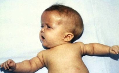 Achondroplasia Infant
