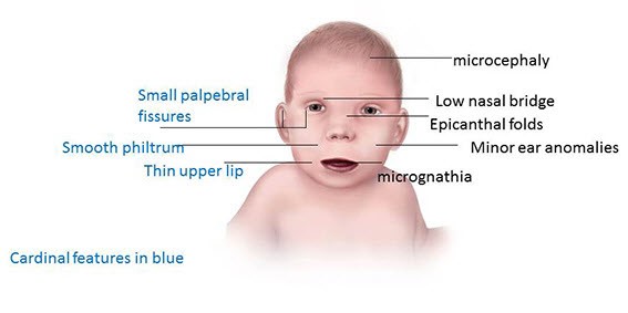 Fetal Alcohol Spectrum Disorders (Facies) – Clinical Eye Openers