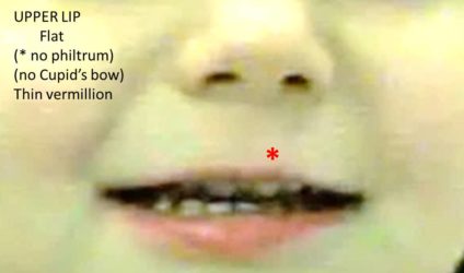 Upper Lip Thin Vermillion