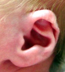 Ear Helix