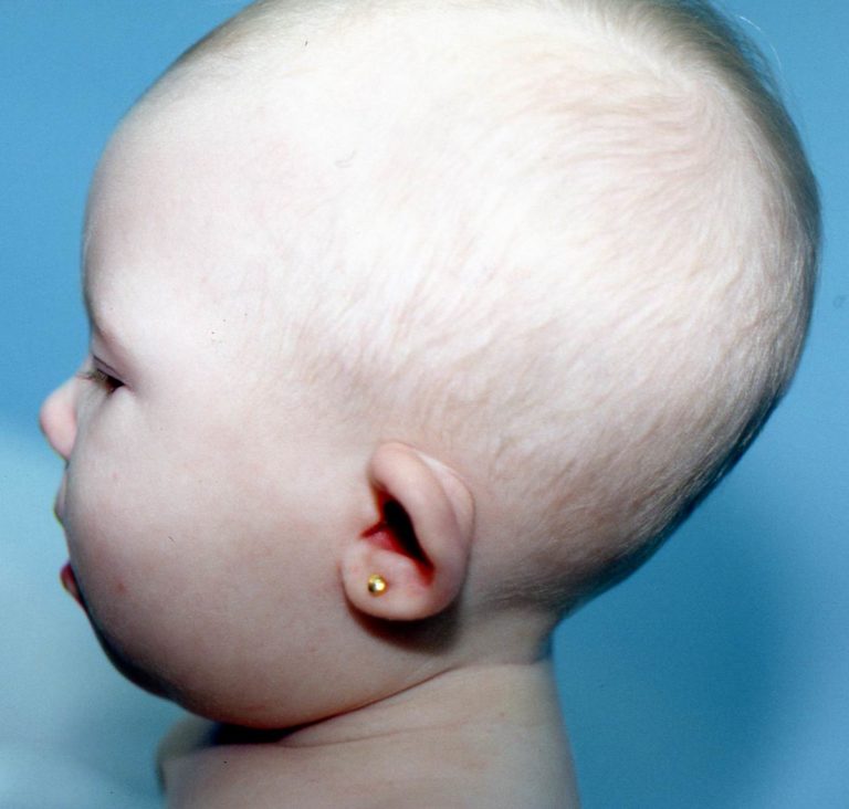 Lop or Cup Ear Clinical Eye Openers