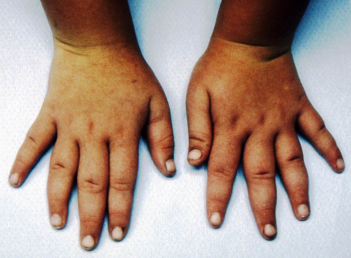 Xlinked Tapered Fingers Clinical Eye Openers