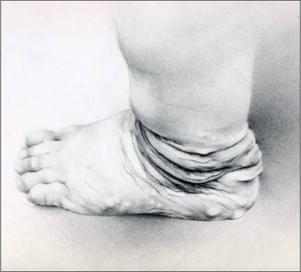 Fallen Socks Sign of Lax Skin - Dermatosparaxis