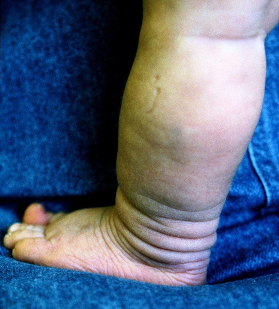 Fallen Socks Sign of Lax Skin - Dermatosparaxis