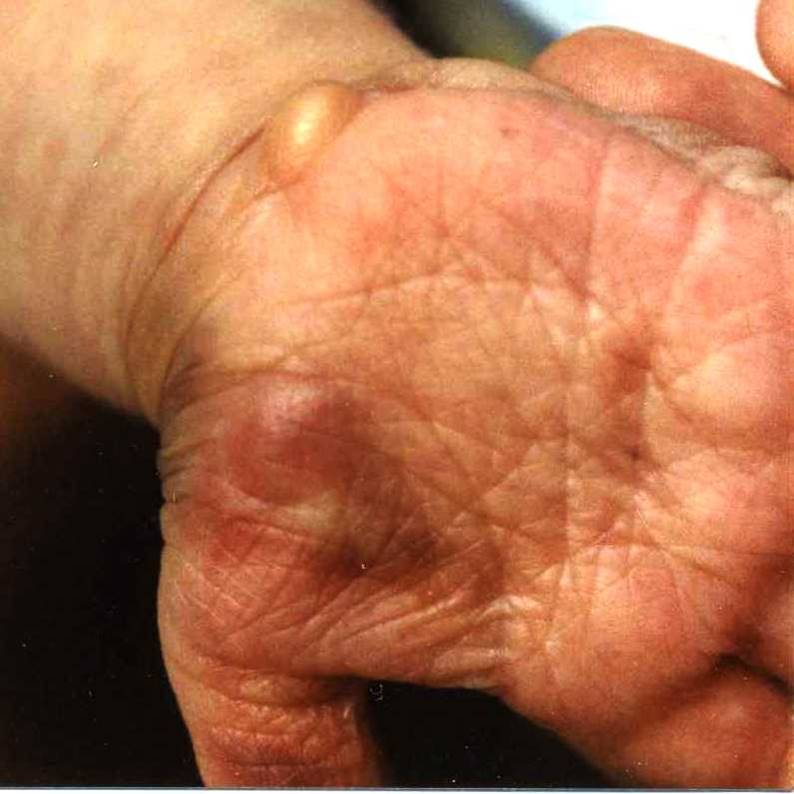 Dermatosparaxis Hand Palm Volar Skin Hernia Dermis