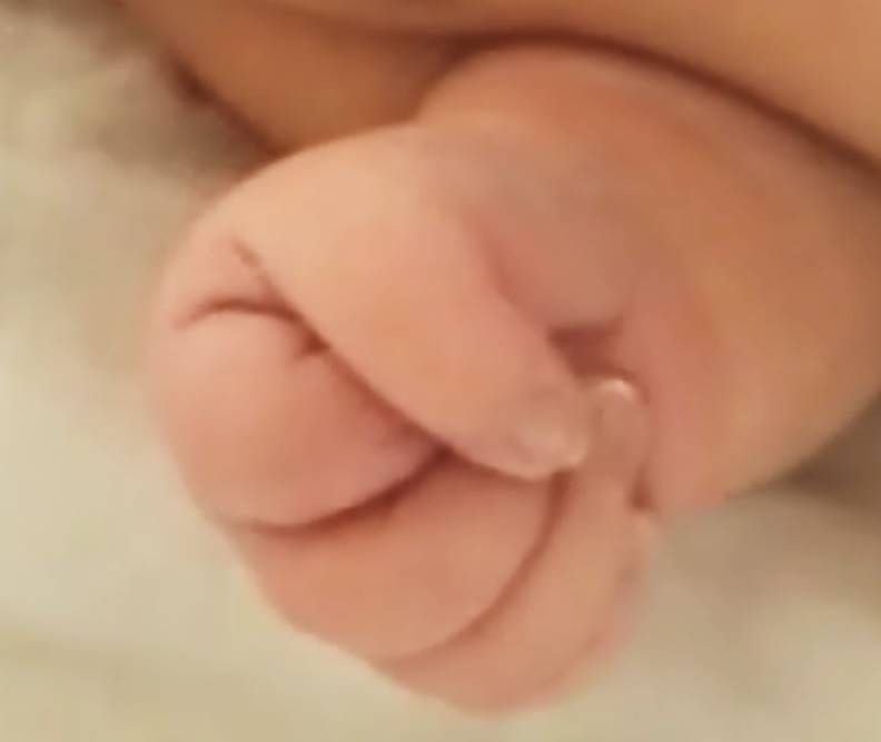 Iniencephaly Finger Contractures